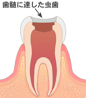 抜髄（ばつずい）とは