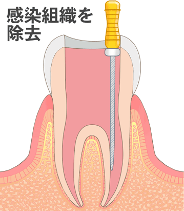 根管のお掃除・殺菌