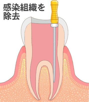 9.ポイント試適