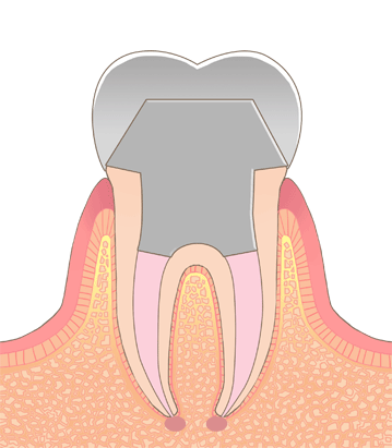 歯冠修復処置